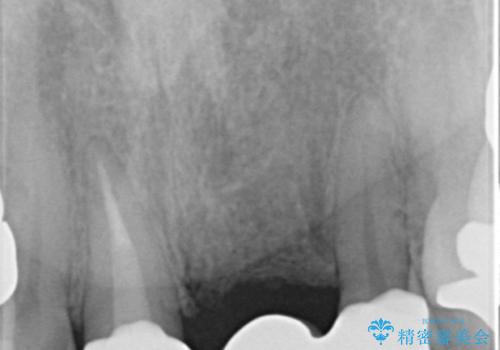 不自然なブリッジ 自然なセラミックでやりかえ 30代女性の治療後