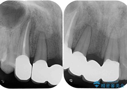 転んで前歯が欠けた 折れた前歯をきっかけに矯正治療で歯列をきれいに整えるの治療後