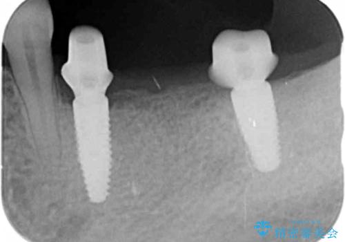 臼歯部インプラント補綴の治療中