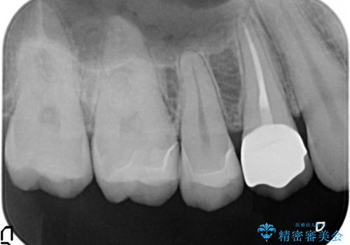 銀歯を白くしたい 隙間がしみるの治療後