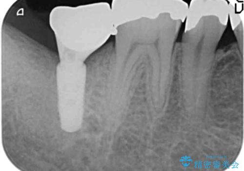 低価格でしっかりとしたインプラント治療 30代男性の治療後