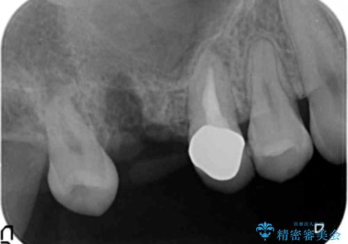 インプラントも入れ歯も嫌 親知らずの移植 20代女性の治療中
