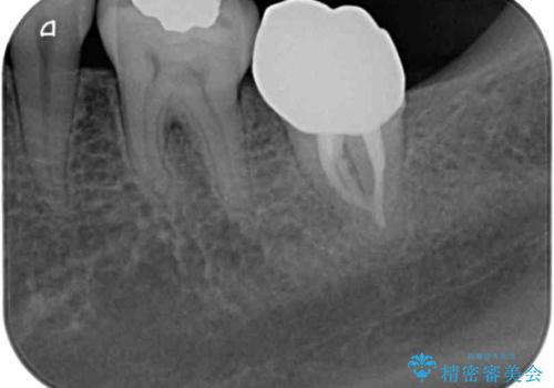 奥歯が痛い 保険治療後に症状が発現した歯のむし歯治療の治療後