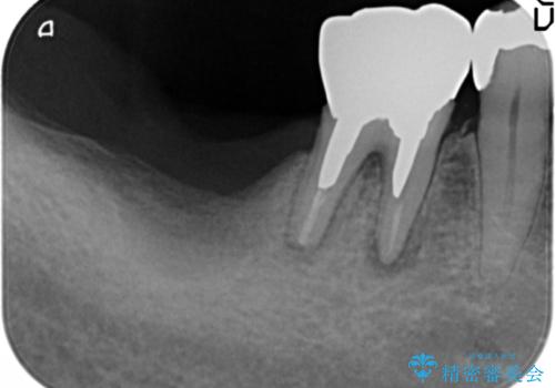 骨が少なくインプラントできないと言われた　下の奥歯のインプラント　60代男性の治療前