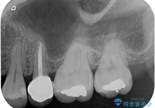 奥歯が痛い 保険治療後に症状が発現した歯のむし歯治療の治療後