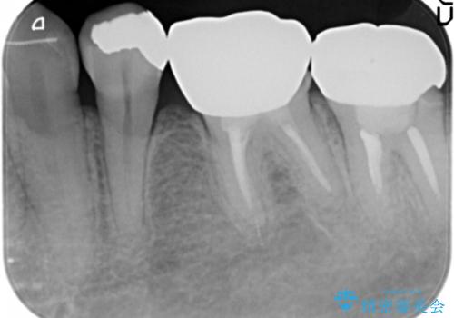 低予算で銀歯を白くしたい 50代女性の治療前