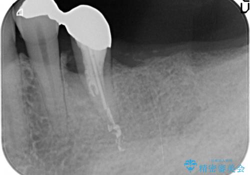 臼歯部インプラント補綴の治療前