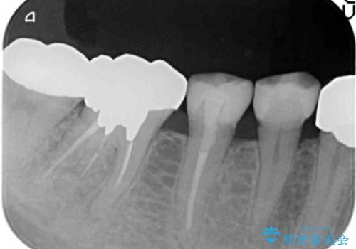 被せ物を入れたばかりの歯が痛む 40代女性の治療後