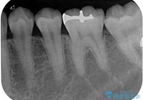 セラミックとゴールド 奥歯のむし歯治療の治療前