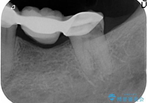 歯が痛い 深いう蝕により神経が死んでいる 50代女性の治療前