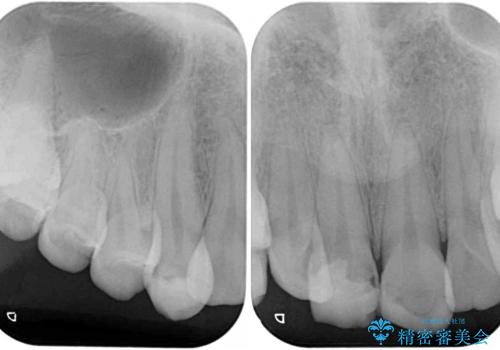 転んで前歯が欠けた 折れた前歯をきっかけに矯正治療で歯列をきれいに整えるの治療前