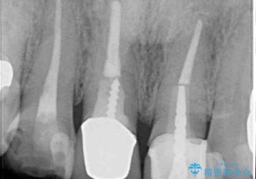 鼻の下を押すと痛い 抜歯を避けてきた歯を抜歯して自然な口元にの治療前