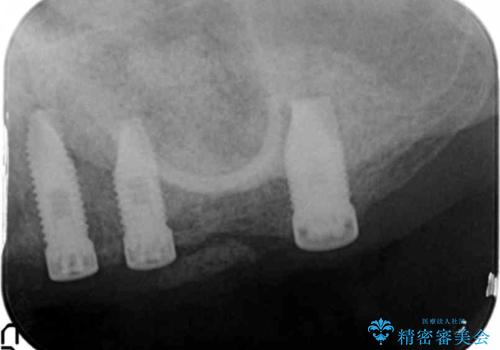 歯肉移植(FGG)による角化歯肉の獲得で長持ちするインプラントへ 50代男性の治療中