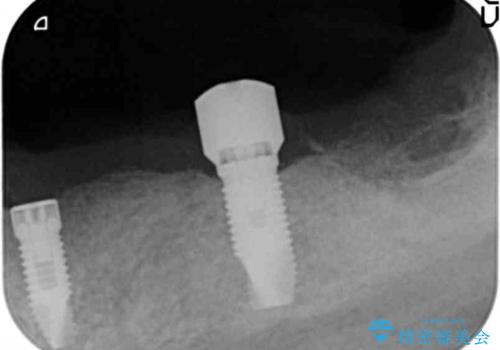 歯がぐらぐらで咬めない 奥歯のインプラント 50代男性の治療中