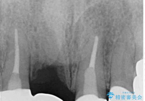 鼻の下を押すと痛い 抜歯を避けてきた歯を抜歯して自然な口元にの治療後