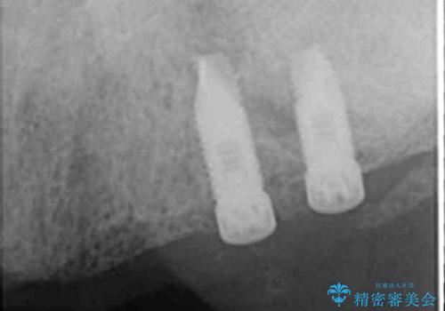 喫煙を再開してインプラント周囲炎に リカバリー治療 50代男性の治療前