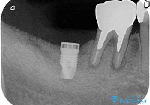 骨が少なくインプラントできないと言われた 下の奥歯のインプラント 60代男性の治療中