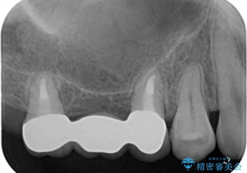 インプラントも入れ歯も嫌 親知らずの移植 20代女性の治療後