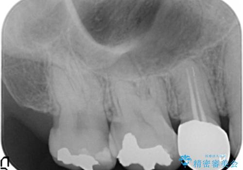 低予算で銀歯を白くしたい 50代女性の治療前