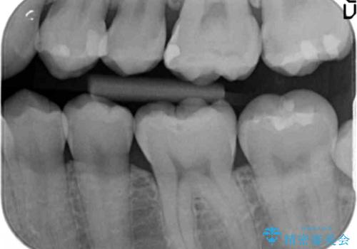 奥歯の虫歯　歯の間を広げてセラミックでしっかり治療の治療前