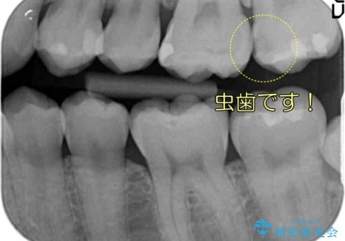 奥歯の虫歯 歯の間を広げてセラミックでしっかり治療の治療前