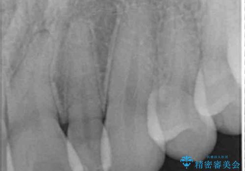 小さい前歯を整える セラミック矯正の治療前
