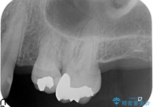 小矯正を伴う臼歯部ブリッジ治療の治療前