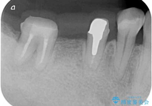 「ブリッジのところで噛むと痛い」 神経組織が原因の咬合痛の治療中