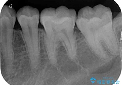 セラミックとゴールド 奥歯のむし歯治療の治療後