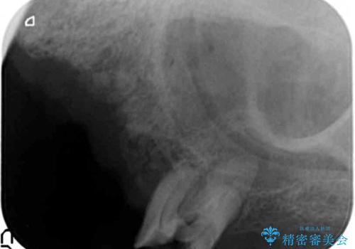 歯肉移植(FGG)による角化歯肉の獲得で長持ちするインプラントへ 50代男性の治療前