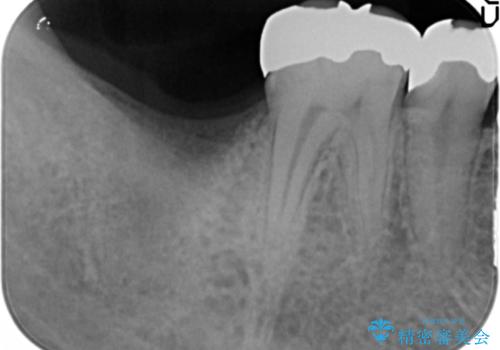 低価格でしっかりとしたインプラント治療 30代男性の治療前