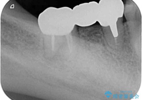 「ブリッジのところで噛むと痛い」 神経組織が原因の咬合痛の治療後