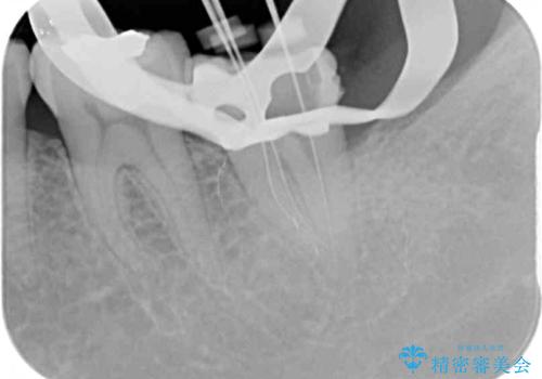 奥歯が痛い 保険治療後に症状が発現した歯のむし歯治療の治療中