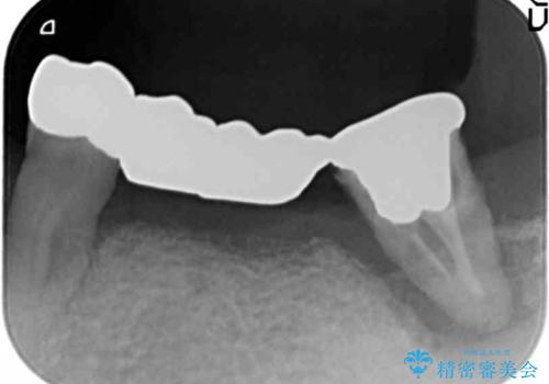 歯がぐらぐらで咬めない 奥歯のインプラント 50代男性の治療前