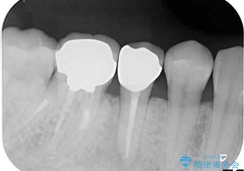 歯肉にできものがある、根管治療からセラミッククラウンまでの治療後