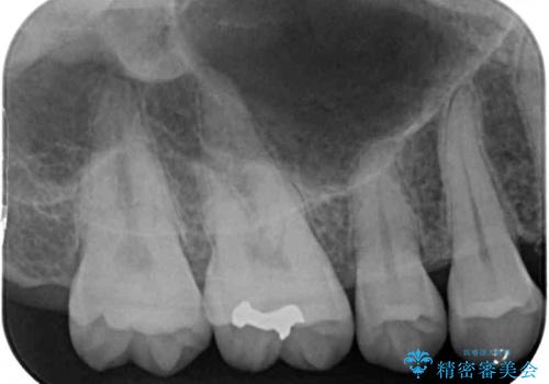 セラミックとゴールド 奥歯のむし歯治療の治療前