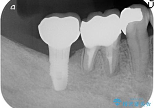 骨が少なくインプラントできないと言われた　下の奥歯のインプラント　60代男性の治療後