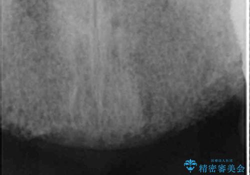 喫煙を再開してインプラント周囲炎に リカバリー治療 50代男性の治療前