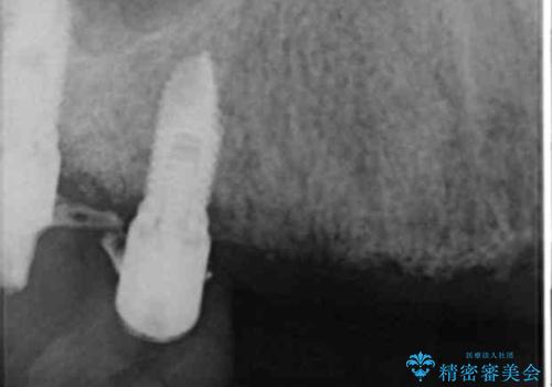 喫煙を再開してインプラント周囲炎に リカバリー治療 50代男性の治療前