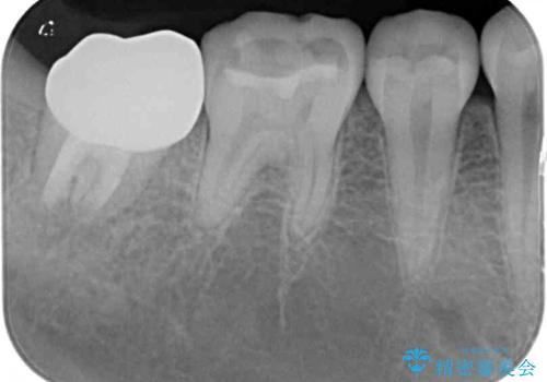 クラウンがすぐに外れてしまう　歯冠長延長術を用いた補綴治療の治療後