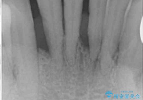 他院で抜歯と言われた歯 歯も神経も残したい 50代男性の治療前