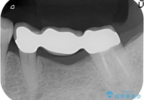 歯が痛い 深いう蝕により神経が死んでいる 50代女性の治療後
