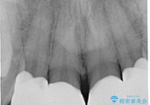 前歯のすき間 セラミックで綺麗に 最短で治療の治療後