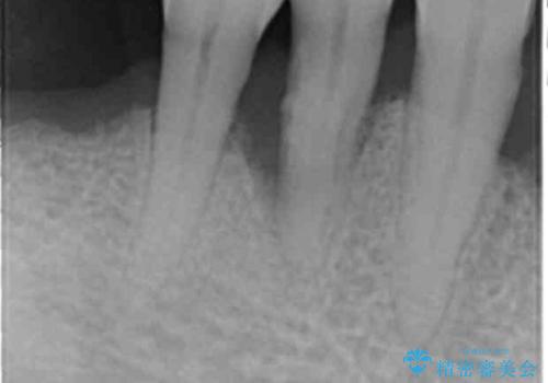 歯がぐらぐら 再生療法で抜かずに残す 50代男性の治療前