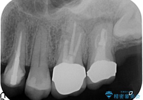 歯ぐきから出る膿　何度治療しても治らない　精密根管治療　50代男性の症例 治療後