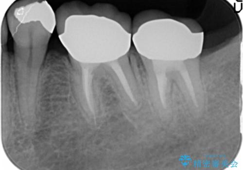 低予算で銀歯を白くしたい 50代女性の治療後
