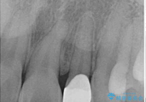 小さい前歯を整える セラミック矯正の治療後