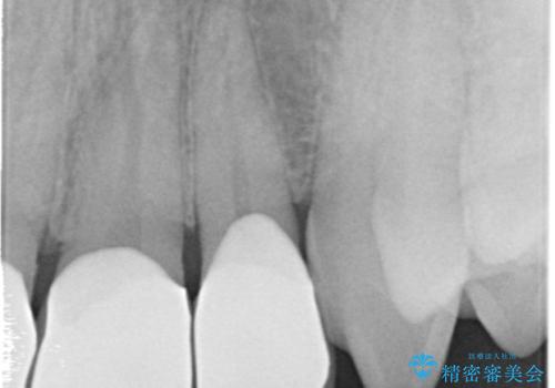 前歯のすき間 セラミックで綺麗に 最短で治療の治療後