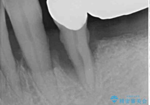 他院で抜歯と言われた歯 歯も神経も残したい 50代男性の治療前
