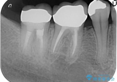 低予算で銀歯を白くしたい 50代女性の治療後